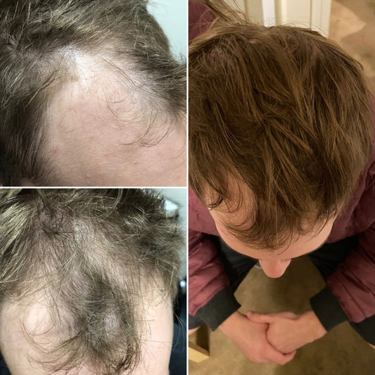 Hair Loss Treatment with Low-Level Light Therapy (LLLT): Benefits & Results
