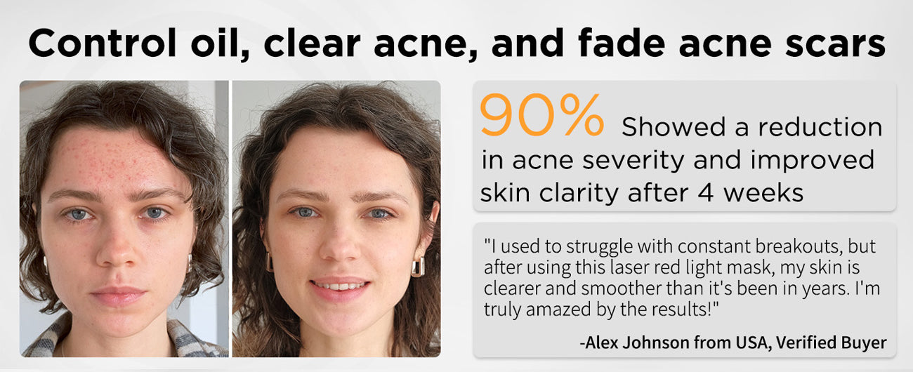 CLEAR ACNE