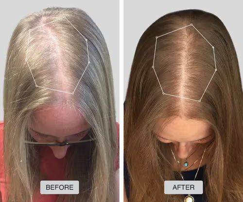 my friends even think I've had a hair transplant!